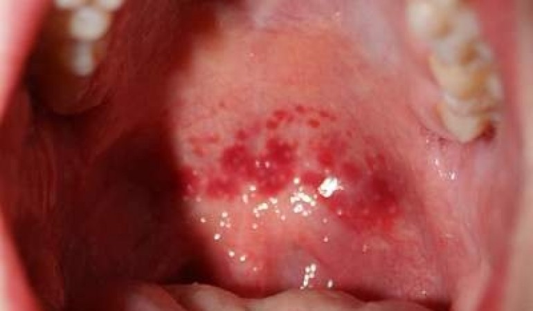 Angine de Ludwig - Hình ảnh minh họa